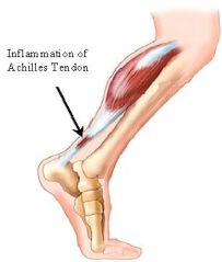 achillies-tendon2