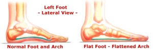 flat-foot-arch1