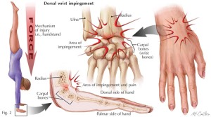 Dorsal Impingement/Wrist Extension Pain in Gymnastics Reference Picture  http://www.hughston.com/hha/b_15_4_3b.jpg 