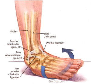 Ankle Inversion Sprain Reference - http://gymnasticsinjuries.files.wordpress.com/2012/10/anklesprainimage.jpg
